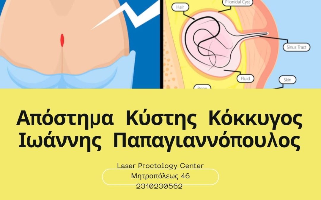 απόστημα κύστης κόκκυγος | Πρωκτολόγος Θεσσαλονίκη